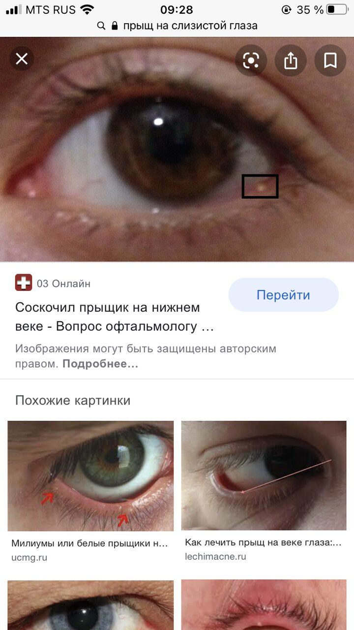 На Нижнем Веке Прыщик Фото — Картинки фотографии