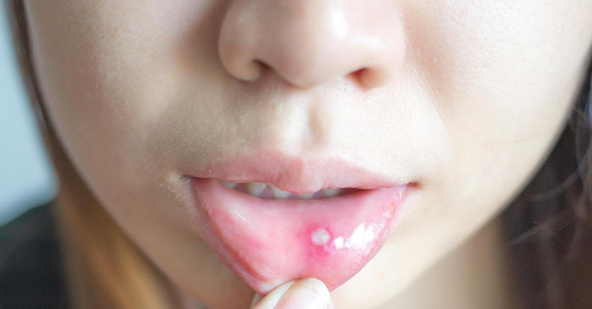 Прыщик на губе с внутренней стороны - герпес или стоматит?