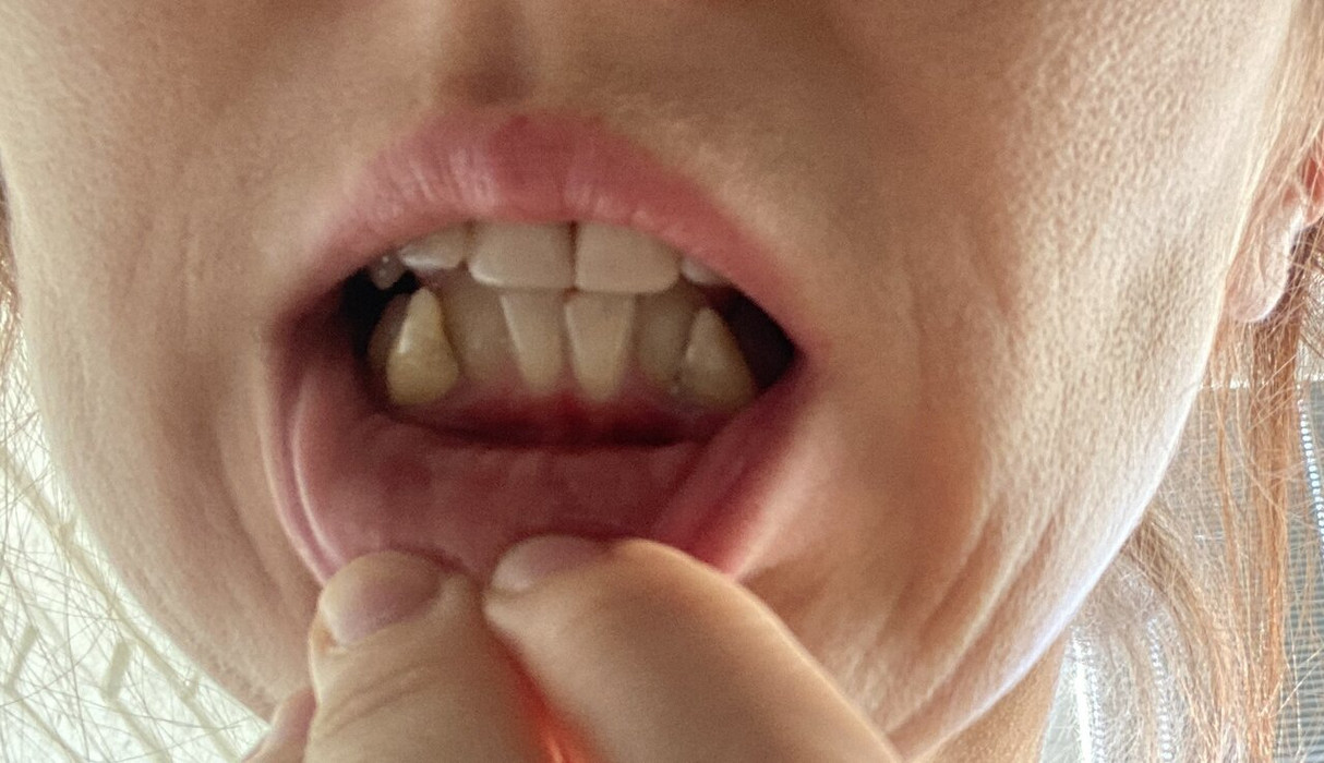 Кривые зубы