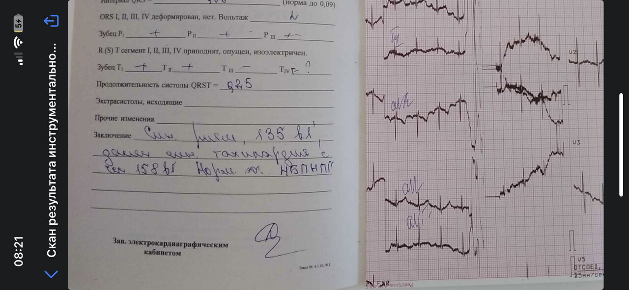 По ЭКГ син.тахикардия и НБПНПГ