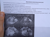 Повторная фоликулометрия