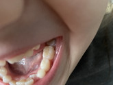 Зубы в 6 лет