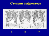 Почка или нерв защемило?