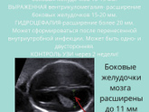 Вентрикуломегалия. 2 скрининг