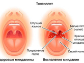 У кого-то был тонзиллит?