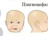 Привычный наклон головы