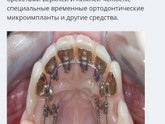 Брекеты при удалённых жевательных зубах