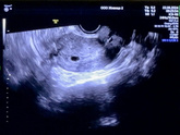 Первое УЗИ 🐣🤰🥰 5 нед 2 дня ( 23 ДПО)