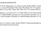 Повышенный риск трисомия 21 у одного из двойни