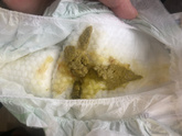 Понос
