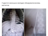 Проглотил фольгу. А может и нет. Что делать?