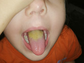 Желтый язык у ребёнка
