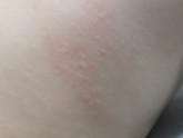 Аллергия у ребёнка