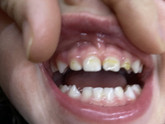 Зубы. Рыжие полоски на зубах