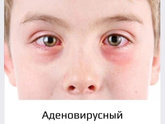 Аденовирусный конъюнктивит