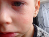 Аллергия на животных у детей