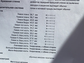 Ахондроплазия