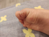 Лопнул палец у дочи