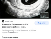Пол ребёнка с 11-12 недель