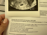 Первое узи. 5,7 акушерских.