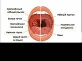 Тонзиллит
