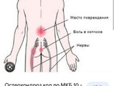 Остеохондроз