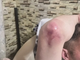 Воспаление и надрыв сухожилий