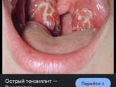 Болит горло