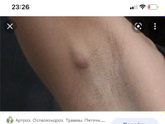 Шишка под мышкой!!😟