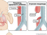 Атрезия пищевода 3