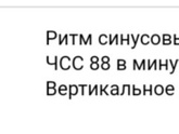 ЭКГ