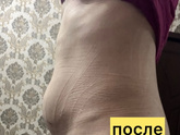 После операции диастаза прямых