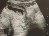 pregnancy