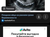 Двойня или гематома? Выделения немного есть коричневые, в основном по утрам, но не всегда.