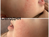Бесконечная аллергия 😫🤯😵💫