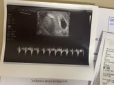 Сердцебиение малыша 6нед3 дня