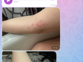 Девочки в шоке, что это аллергия?? Проснулась дочка утро вот такая, и даже царапины, я не понимаю что это такое, завтра к педиа…