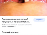 Тонзиллит