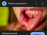 Стоматит