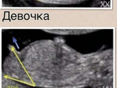 Пол ребёнка