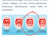 Сильно увеличины миндалины