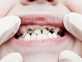 Проблемные зубы у ребенка