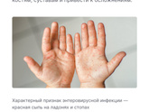 Энтеровирусная инфекция В