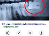 Зуб мудрости, Ретинировоный, растёт