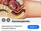 Девочки, кто делал амниоцентез? Как всё прошло? Не подтекали ли потом воды ?