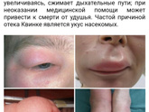 БЦЖ и отек Квинке
