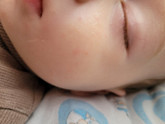 Сыпь на лице у ребенка