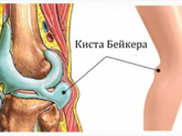 Киста Беккера