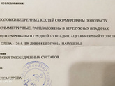 Дисплазия ТБС