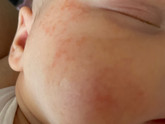 Не проходит уже несколько месяцев аллергия у ребенка 🤕